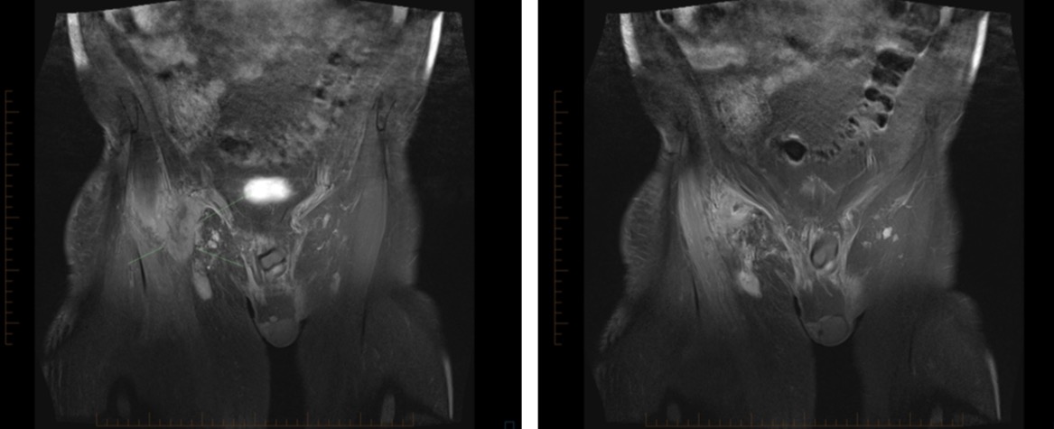 Figure 3 for case Vascular leiomyosarcoma ( RID4387 )
